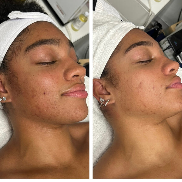 AHA/BHA Clarifying Pads Gleaux Aesthetics Skincare
